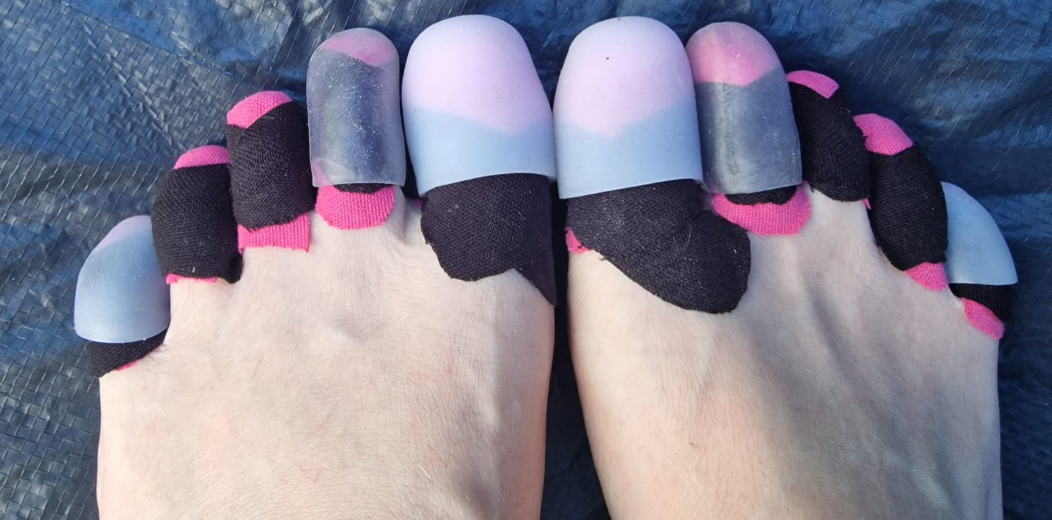 A photo of Ruth's feet with the toes taped up with pink and black tape, and with gel toe caps over several toes.