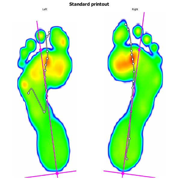 Picture of barefoot running, with strong red hotspots under the ball of the feet.