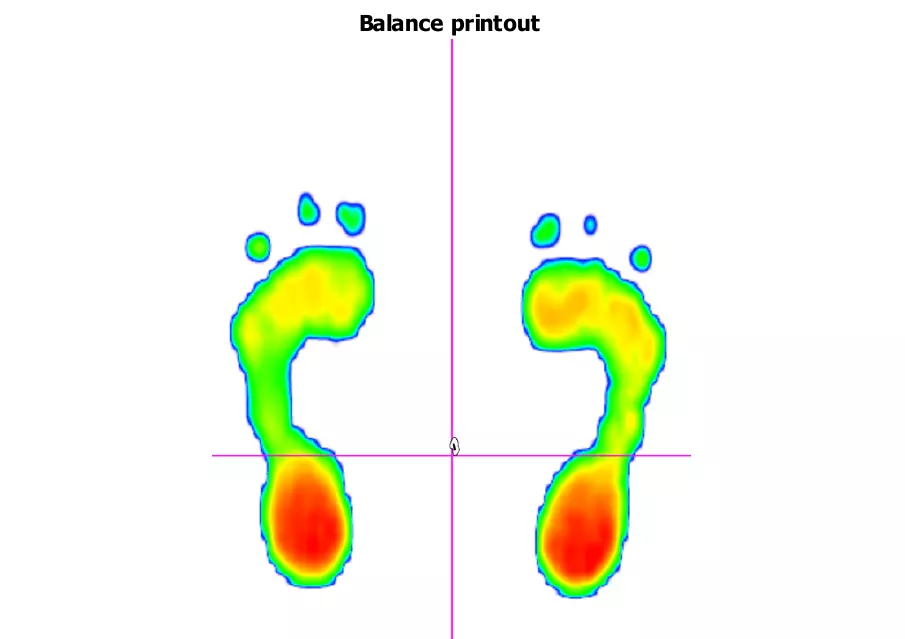 An image showing both feet with large red pressure areas through both heels