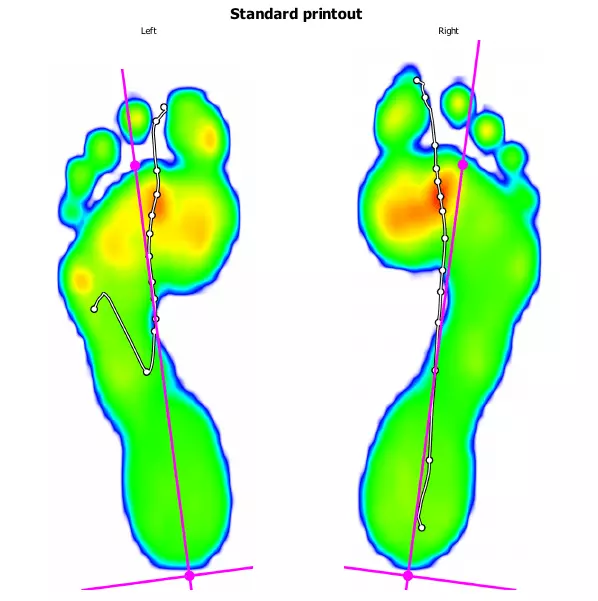Picture of barefoot running, with strong red hotspots under the ball of the feet.