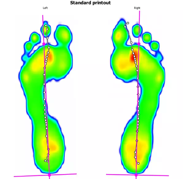 image of barefoot walking with some small red hotspots.